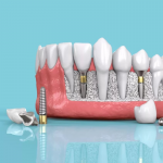 Имплантация зубов: современные технологии и преимущества